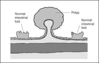 graphic of polyp in intestinal fold