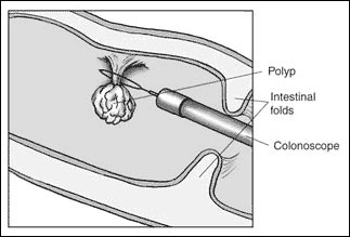 graphic of colonoscopy