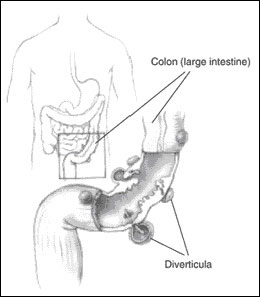 Diverticulosis and Diverticulitis