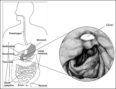 Peptic Ulcer Treatment