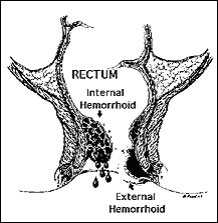 Hemorrhoids