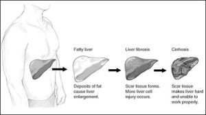 Nonalcoholic Steatohepatitis