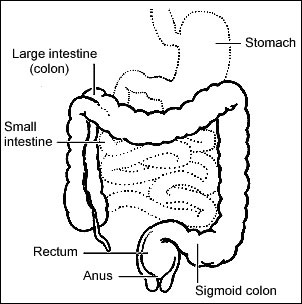 Ulcerative Colitis