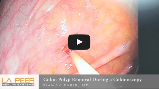 Image of Colon Polyp Removal During Colonoscopy Click to See Video