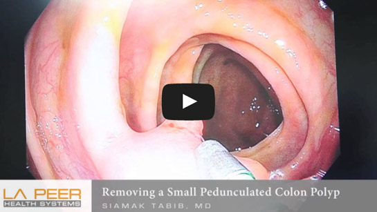 Image of Dr. Tabib Performs Colonoscopy Polyps Removal Click to See Video